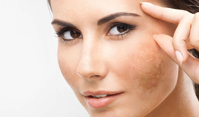 Rimedi naturali per le macchie del viso: come eliminarle? 1 macchie viso rimedi naturali